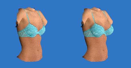 virtual breast augmentation
